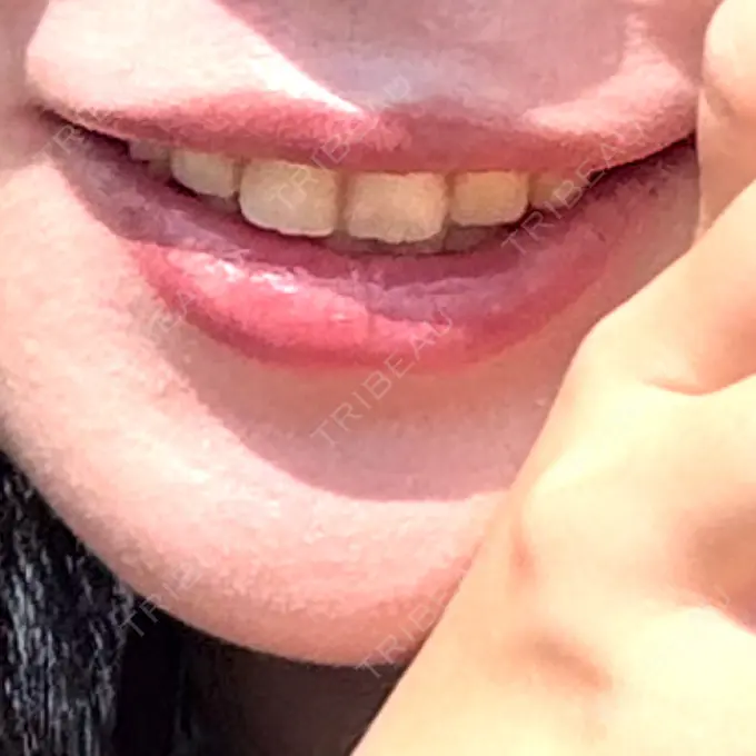 ボトックス（ガミースマイル） 形成外科と美容外科のクリニック池袋 AFTER メイン用