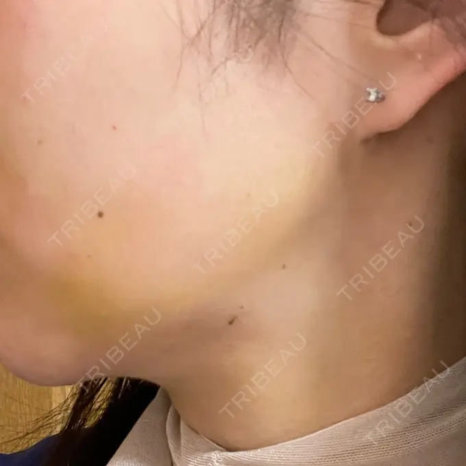 脂肪吸引（顔） / ジョールファット除去 / ボトックス（エラ・小顔） アリエル美容クリニック 大宮院 DAY 7 メイン用