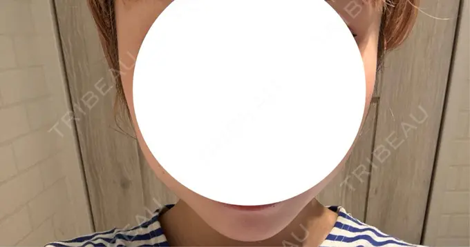 ボトックス（エラ・小顔） 湘南美容クリニック 横浜院 DAY 2 メイン用