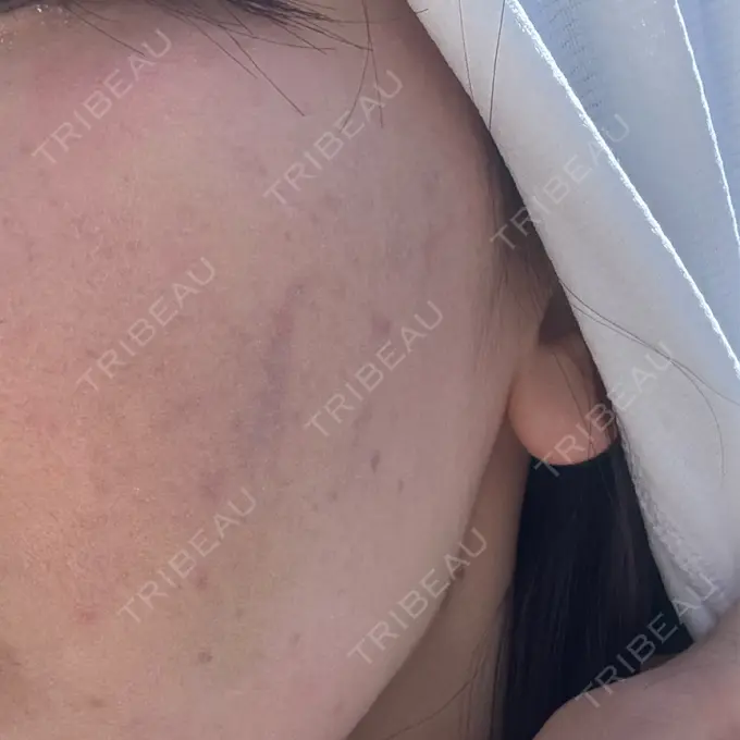 サブシジョン / 肌育注射（ジュベルックなど） 東京シルククリニック 新宿院 DAY 8 メイン用