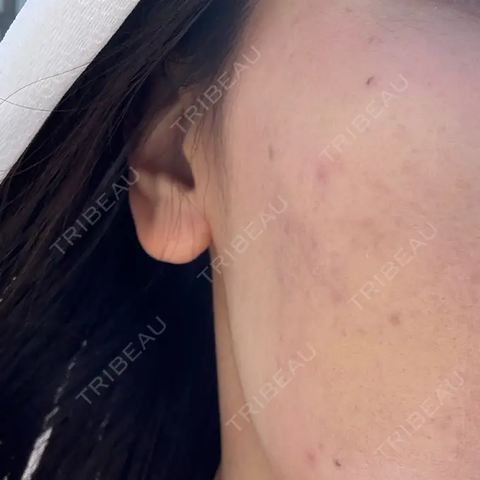 サブシジョン / 肌育注射（ジュベルックなど） 東京シルククリニック 新宿院 DAY 8 メイン用