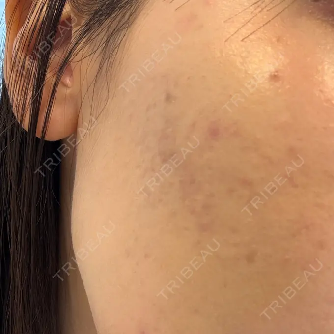 サブシジョン / 肌育注射（ジュベルックなど） 東京シルククリニック 新宿院 DAY 9 メイン用