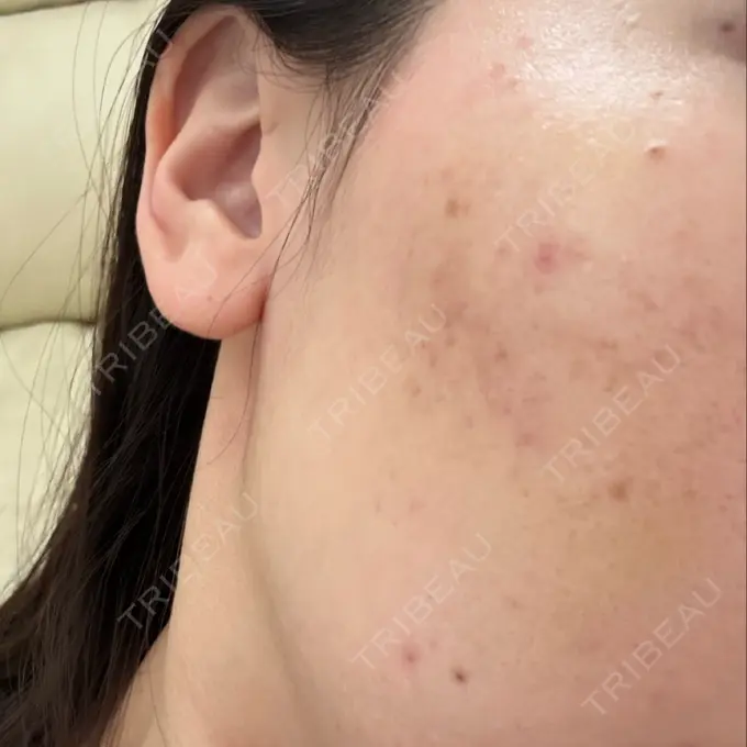 サブシジョン / 肌育注射（ジュベルックなど） 東京シルククリニック 新宿院 AFTER メイン用