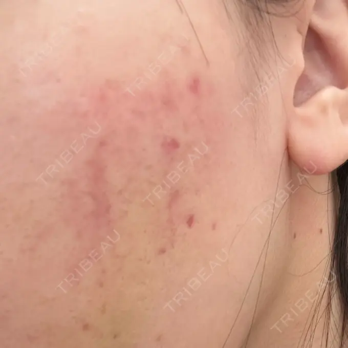 サブシジョン / 肌育注射（ジュベルックなど） 東京シルククリニック 新宿院 DAY 10 メイン用