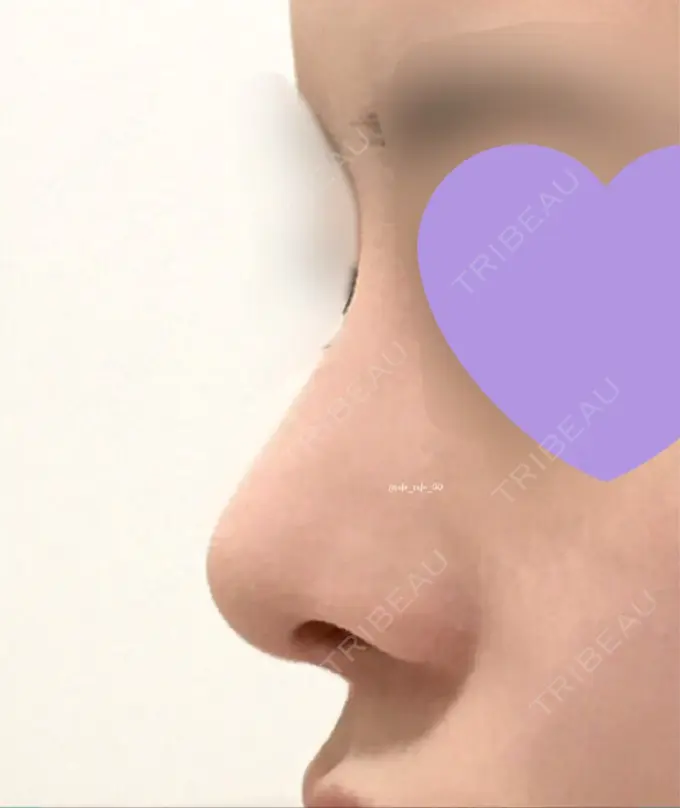 鼻尖形成（切開） / 鼻中隔延長（切開） / 軟骨移植 / 眉間プロテーゼ / 鼻修正 ミナ美容外科 DAY 82 メイン用