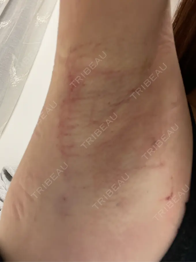 ワキ汗治療（レーザー） ルラ美容クリニック 渋谷本院 DAY 0 メイン用