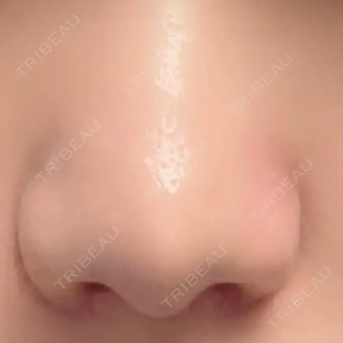 小鼻縮小（切開） / ボトックス（エラ・小顔） / ヒアルロン酸注入（鼻翼基部） eクリニック 福岡院 AFTER メイン用