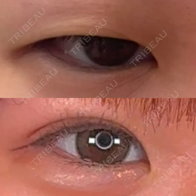 二重埋没 / ヒアルロン酸注入（涙袋） アリエル美容クリニック 横浜院 DAY 36 メイン用