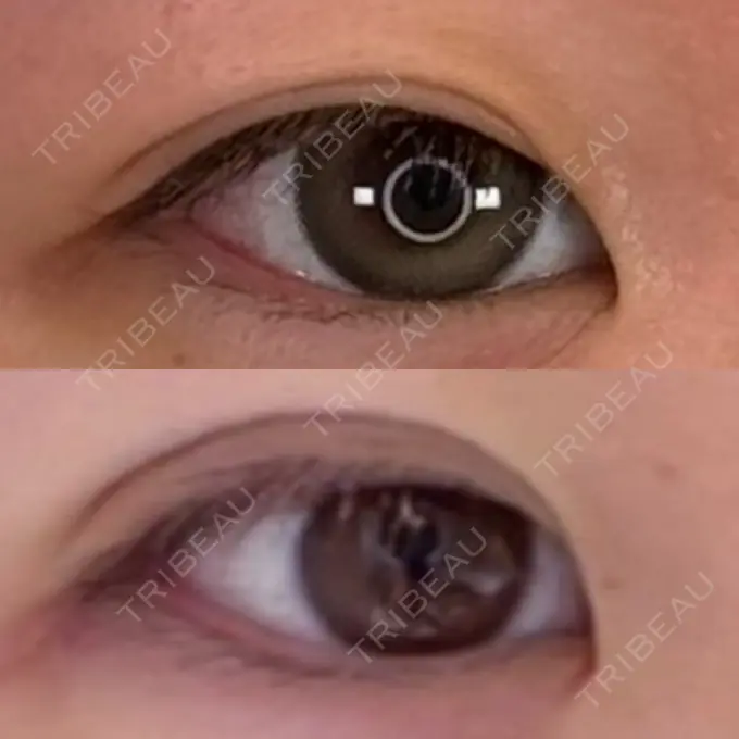 二重埋没 / ヒアルロン酸注入（涙袋） アリエル美容クリニック 横浜院 AFTER メイン用