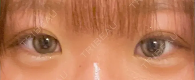 二重埋没 / ヒアルロン酸注入（涙袋） アリエル美容クリニック 横浜院 DAY 36 メイン用