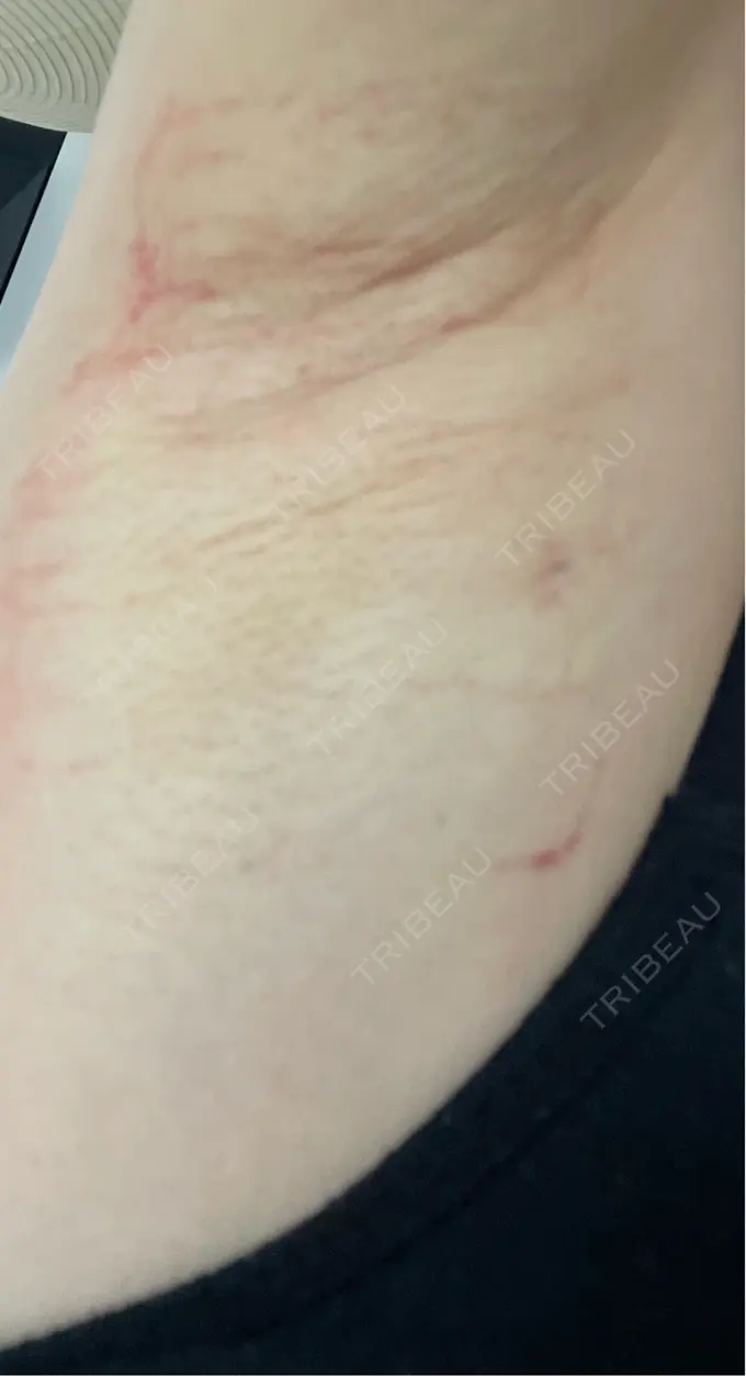 ワキ汗治療（レーザー） ルラ美容クリニック 渋谷本院 DAY 1 メイン用