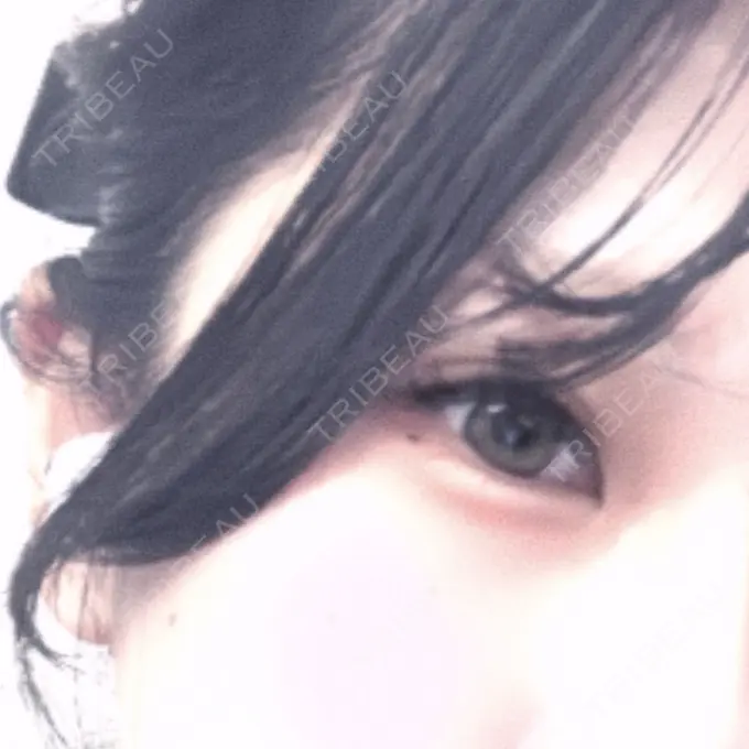 ヒアルロン酸注入（涙袋） ルヴィクリニック イオンドーム前院 AFTER メイン用