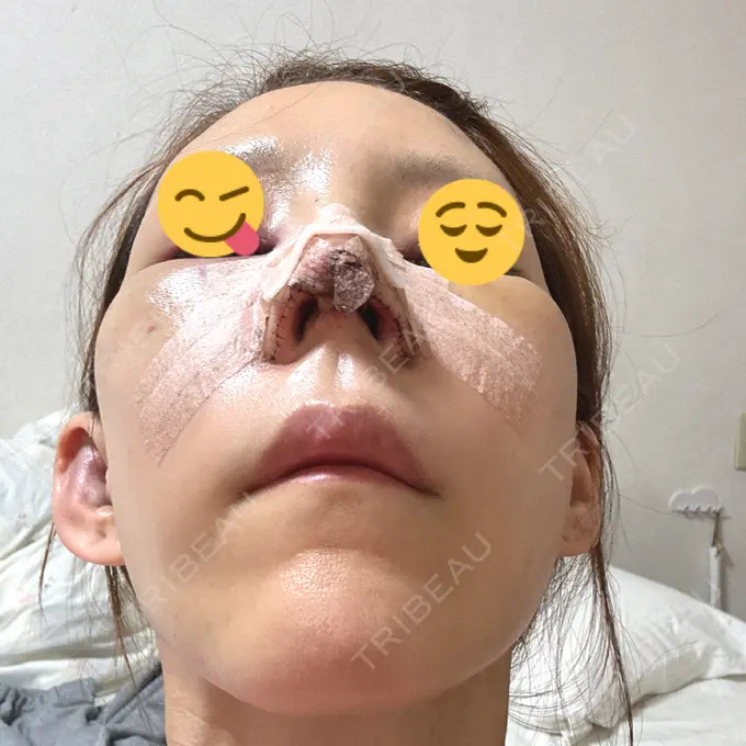 鼻尖形成（切開） / 鼻中隔延長（切開） / 糸リフト / 軟骨移植 / 骨切幅寄せ / 鼻孔縁挙上 / 鼻柱下降・鼻唇角形成（猫手術） / 肌ヒアルロン酸注入（たるみ・シワ改善） / ヒアルロン酸注入（あご） / ボトックス（額） / ヒアルロン酸注入（鼻翼基部） 大阪TAクリニック DAY 1 メイン用