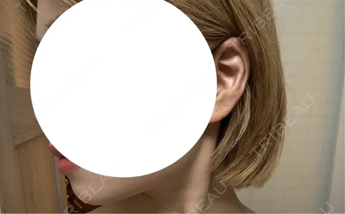 ボトックス（エラ・小顔） 湘南美容クリニック 横浜院 AFTER メイン用