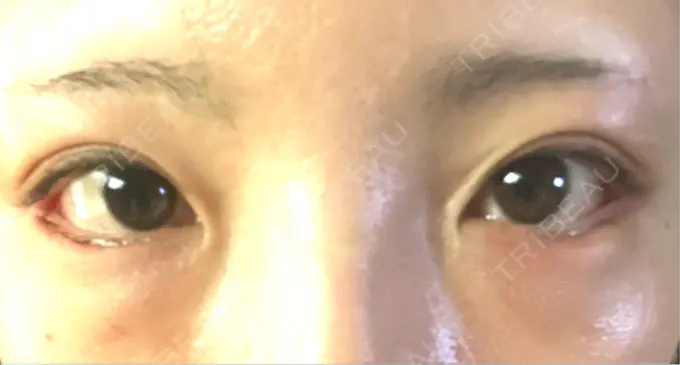 タレ目形成・グラマラスライン（切開） アリエル美容クリニック 横浜院 DAY 28 メイン用