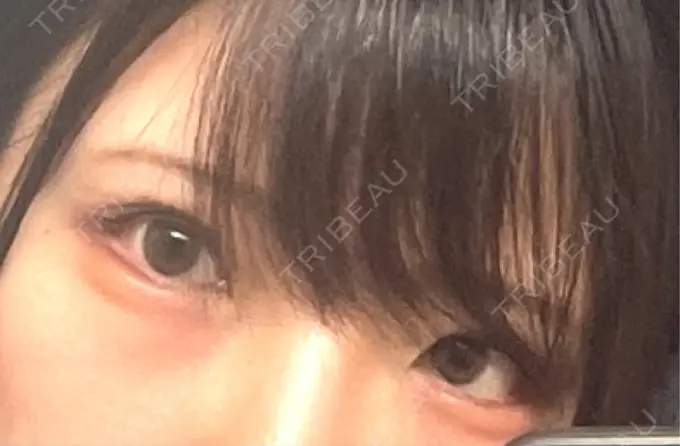 タレ目形成・グラマラスライン（切開） アリエル美容クリニック 横浜院 DAY 35 メイン用