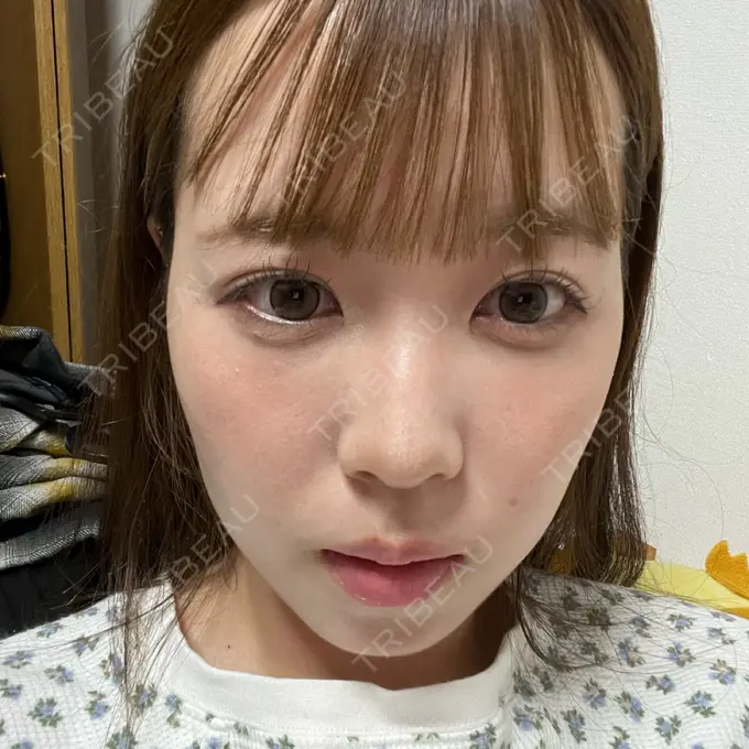 ボトックス（エラ・小顔） 形成外科と美容外科のクリニック池袋 DAY 0 メイン用