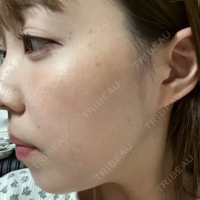 ボトックス（エラ・小顔） 形成外科と美容外科のクリニック池袋 DAY 0 メイン用