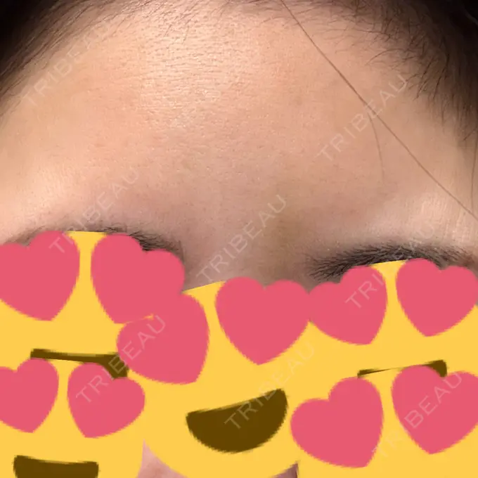 ボトックス（あご） / シワ取りボトックス / ボトックス（眉間） / ボトックス（目尻） 大阪TAクリニック DAY 3 メイン用