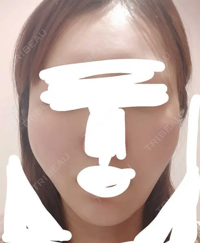 糸リフト アリエル美容クリニック 横浜院 DAY 0 メイン用