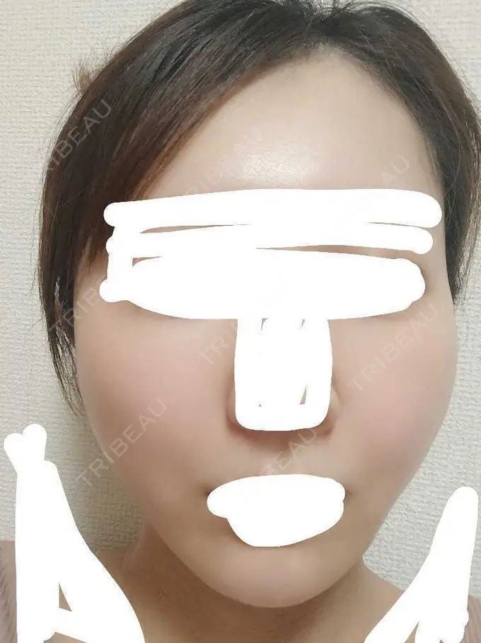 糸リフト アリエル美容クリニック 横浜院 DAY 1 メイン用