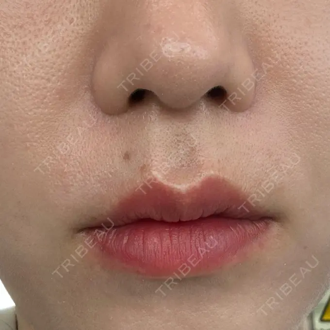 ハイフ（顔） クレオビューティークリニック DAY 1 メイン用