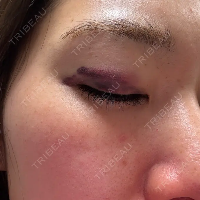 二重埋没 湘南美容クリニック 大阪四ツ橋院 DAY 0 メイン用