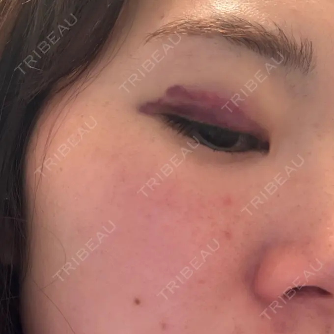 二重埋没 湘南美容クリニック 大阪四ツ橋院 DAY 3 メイン用