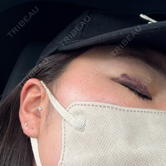 二重埋没 湘南美容クリニック 大阪四ツ橋院 DAY 3 メイン用