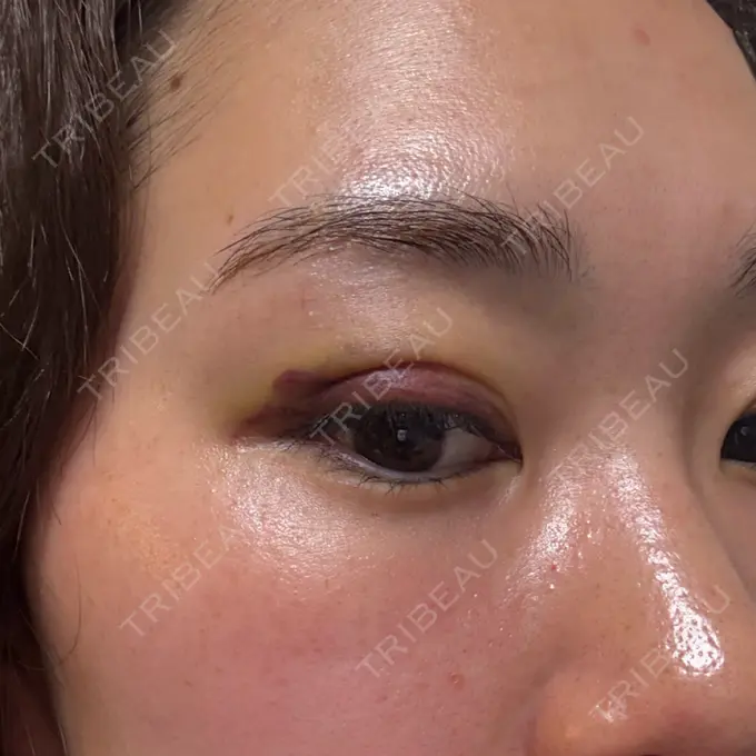 二重埋没 湘南美容クリニック 大阪四ツ橋院 DAY 6 メイン用