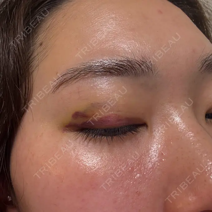 二重埋没 湘南美容クリニック 大阪四ツ橋院 DAY 6 メイン用