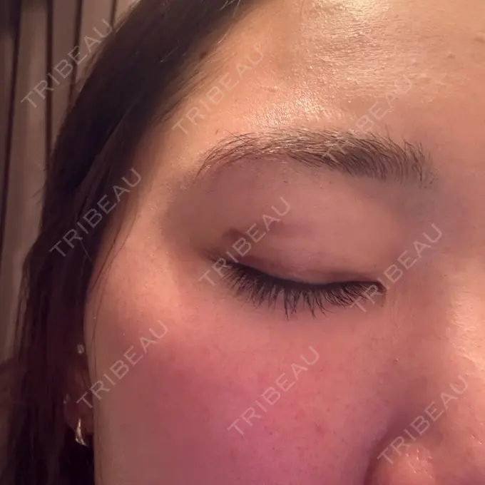 二重埋没 湘南美容クリニック 大阪四ツ橋院 DAY 10 メイン用