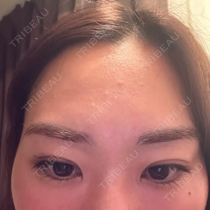 二重埋没 湘南美容クリニック 大阪四ツ橋院 DAY 10 メイン用