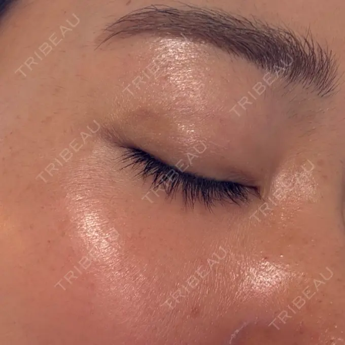 二重埋没 湘南美容クリニック 大阪四ツ橋院 AFTER メイン用