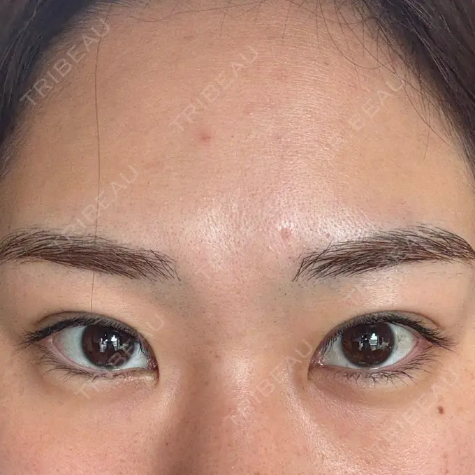 二重埋没 湘南美容クリニック 大阪四ツ橋院 DAY 14 メイン用