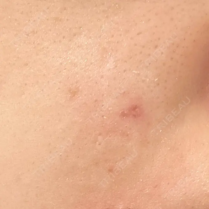 ほくろ・いぼ除去レーザー（肌） みやた形成外科・皮ふクリニック DAY 2 メイン用