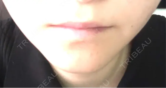 シワ取りボトックス / その他（輪郭） PRISM Beauty Clinic 町田院 DAY 6 メイン用