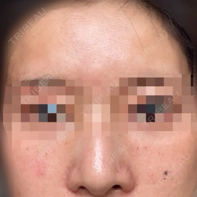 肌育注射（ジュベルックなど） ハナビューティークリニック DAY 2 メイン用