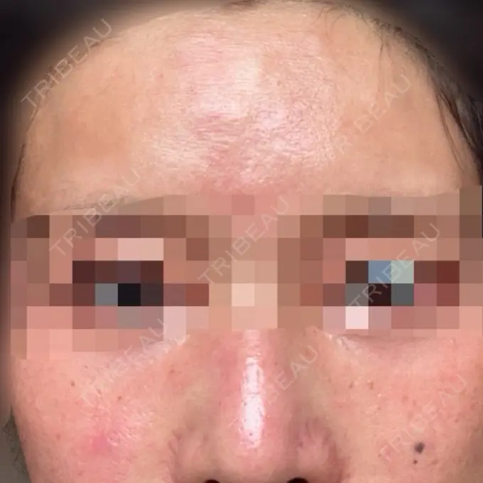 肌育注射（ジュベルックなど） ハナビューティークリニック DAY 0 メイン用