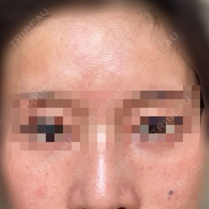 肌育注射（ジュベルックなど） ハナビューティークリニック DAY 1 メイン用