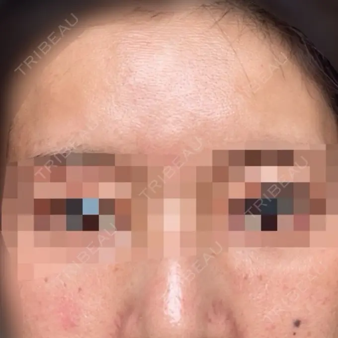 肌育注射（ジュベルックなど） ハナビューティークリニック DAY 7 メイン用