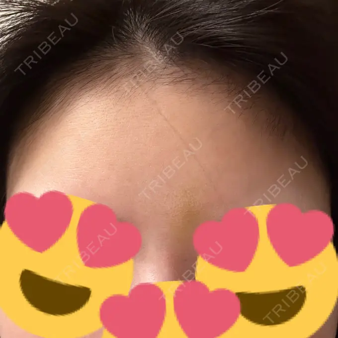 ボトックス（あご） / シワ取りボトックス / ボトックス（眉間） / ボトックス（目尻） 大阪TAクリニック DAY 4 メイン用