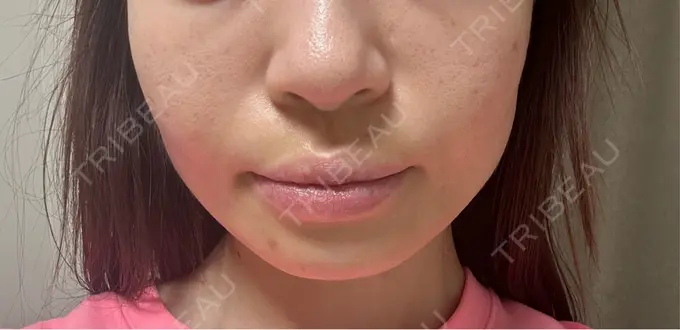 ヒアルロン酸注入（頬） / ヒアルロン酸注入（鼻翼基部） KIMI CLINIC 形成・美容外科 AFTER メイン用