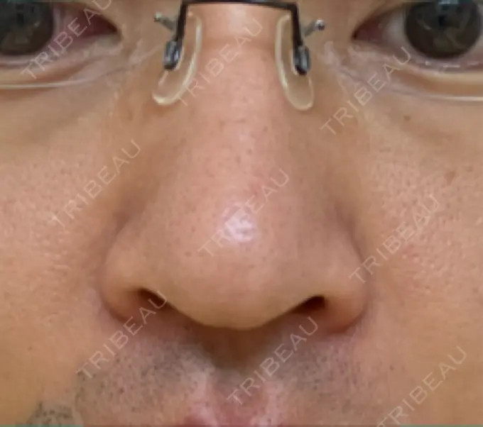 脂肪溶解注射（顔） / その他（鼻） TCB東京中央美容外科 広島院 DAY 5 メイン用