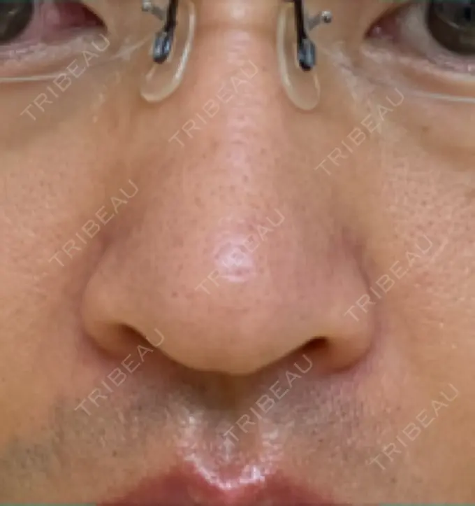 脂肪溶解注射（顔） / その他（鼻） TCB東京中央美容外科 広島院 DAY 6 メイン用