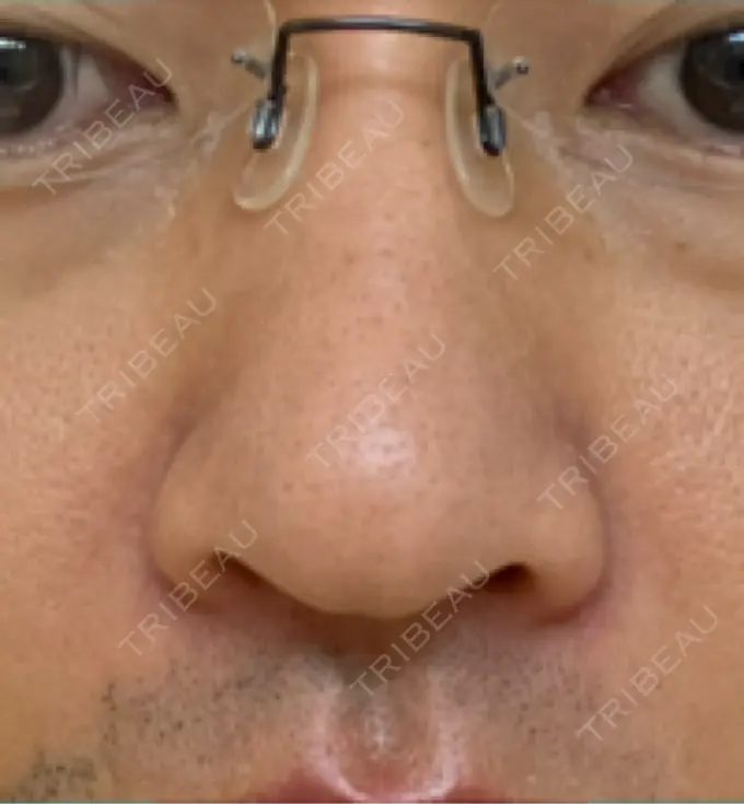 脂肪溶解注射（顔） / その他（鼻） TCB東京中央美容外科 広島院 DAY 7 メイン用