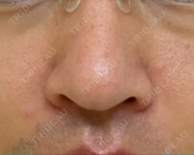 脂肪溶解注射（顔） / その他（鼻） TCB東京中央美容外科 広島院 DAY 8 メイン用