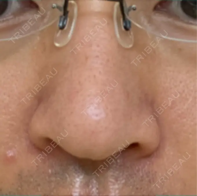 脂肪溶解注射（顔） / その他（鼻） TCB東京中央美容外科 広島院 DAY 9 メイン用