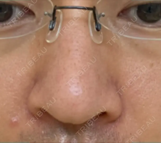 脂肪溶解注射（顔） / その他（鼻） TCB東京中央美容外科 広島院 DAY 10 メイン用