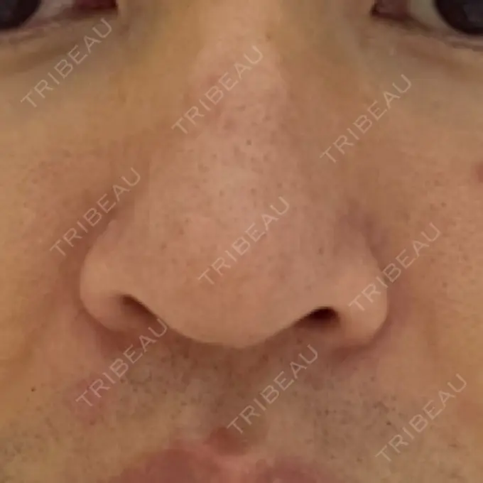 脂肪溶解注射（顔） / その他（鼻） TCB東京中央美容外科 広島院 AFTER メイン用